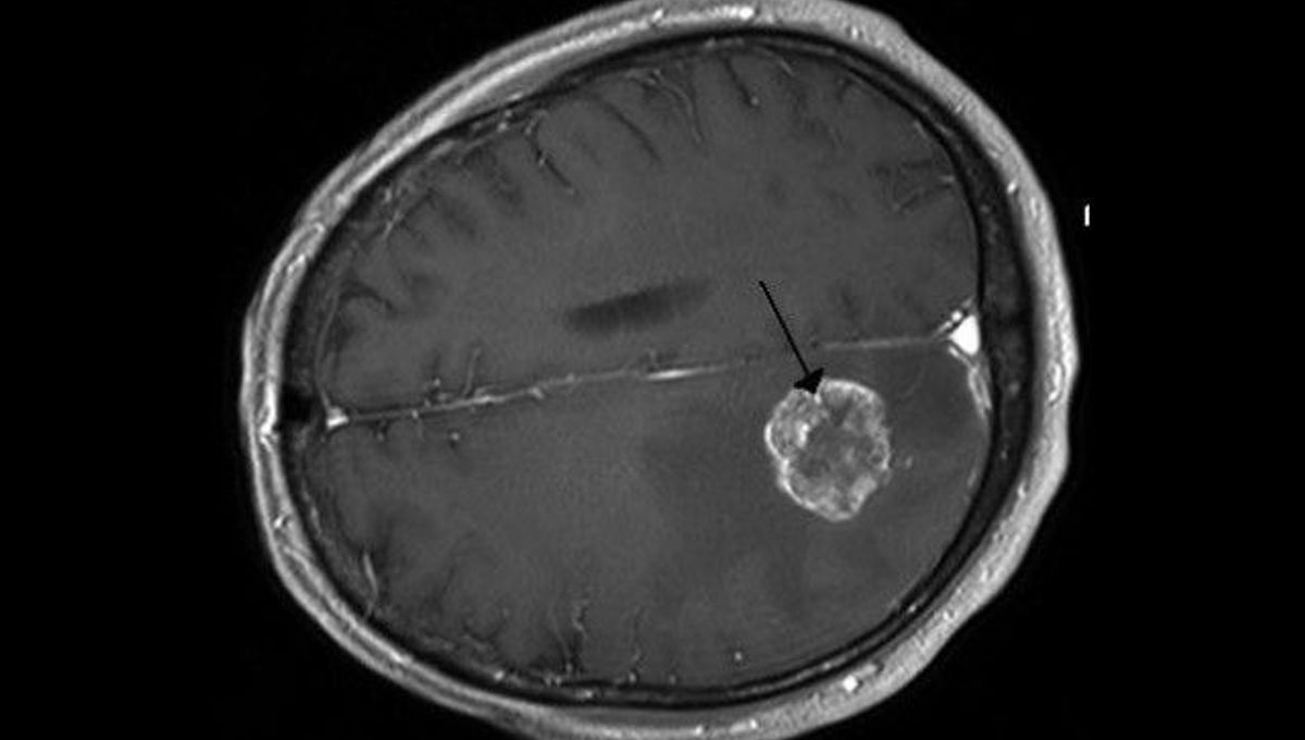 Crossing BloodBrain Barrier Could Open Up New Treatment Options for Alzheimer’s, Cancer