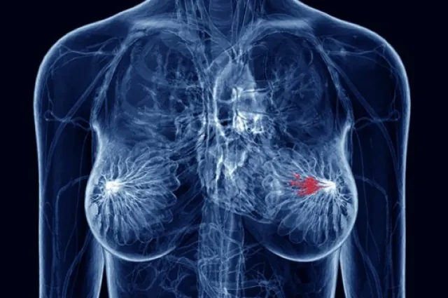 健康・医学 Breast Cancer Secretory carcinoma of the breast with multiple distant