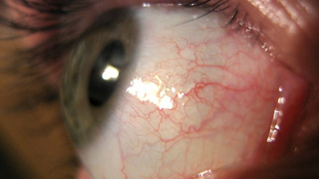 The EyeOpening Parasite That Can Get In Through Your Contact Lens IFLScience