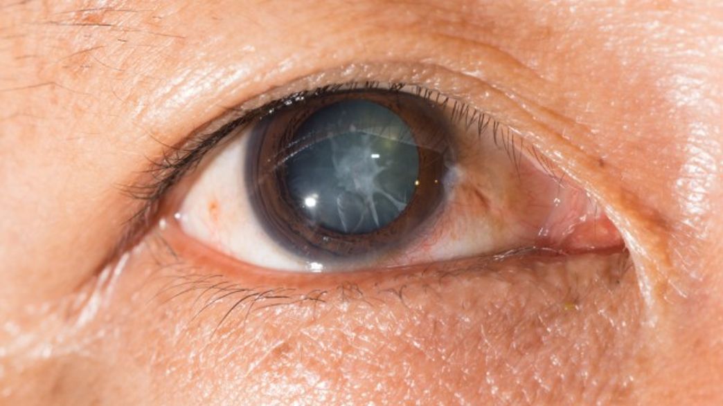 New Eye Drops Can Dissolve Cataracts With No Need For Surgery IFLScience