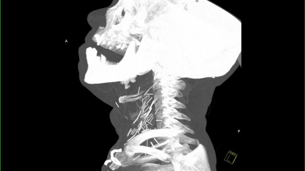 Images Appear To Show Broken Heroin Needles Stuck In Patient's Neck