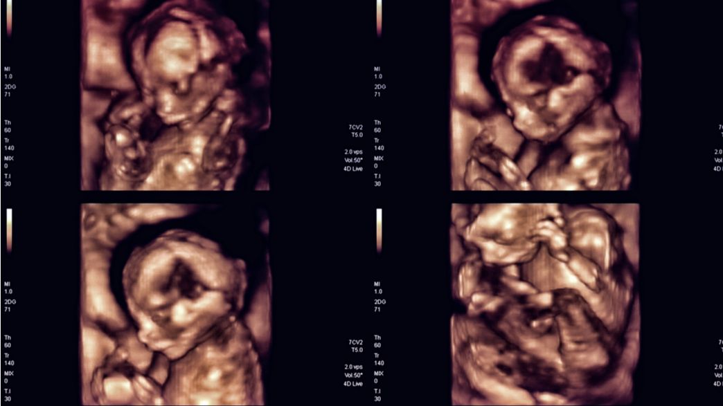 Autism Appears Unrelated To Ultrasounds During Pregnancy IFLScience