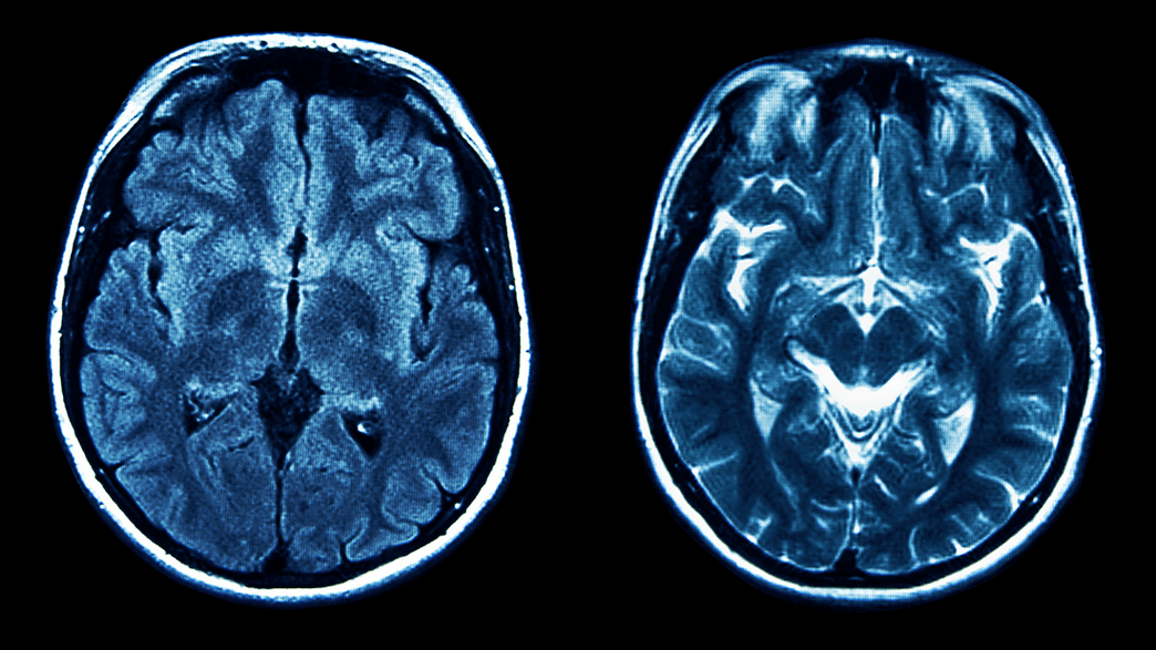 Strange Cases Of Amnesia Keep Cropping Up In Massachusetts. Now