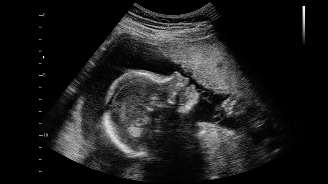 Laboratory analysis exploring genetic contributions to autism