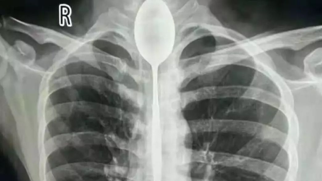 Doctors Extract Huge Spoon From Man S Throat A Whole Year After He Swallowed It