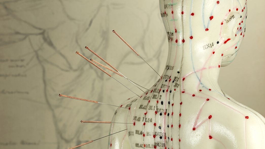Doctors Find Acupuncture Needles Embedded In 94YearOld Woman’s Spine