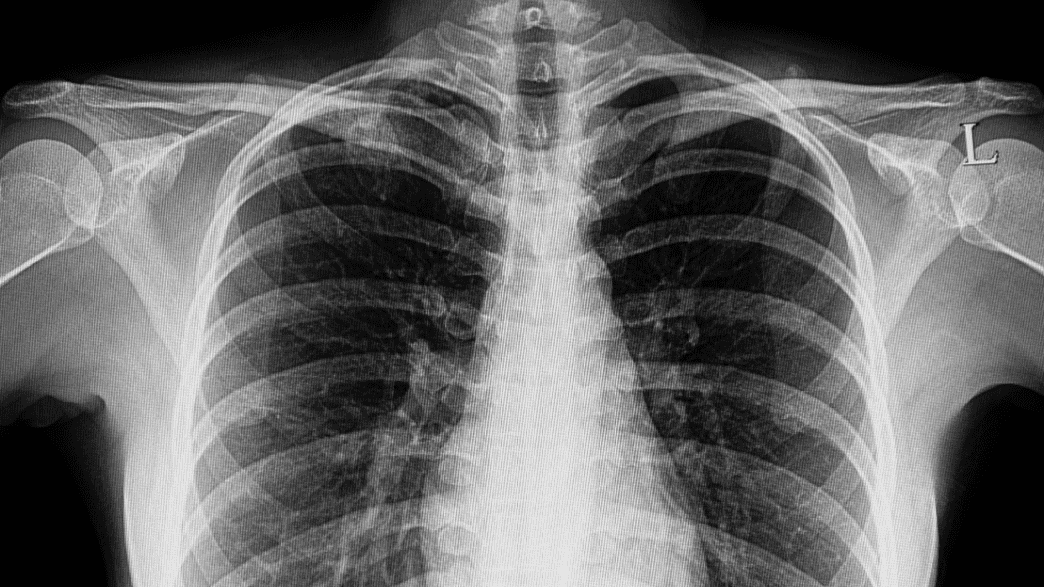 Woman Who Received Lung Transplant Developed Peanut Allergy From Her Donor IFLScience