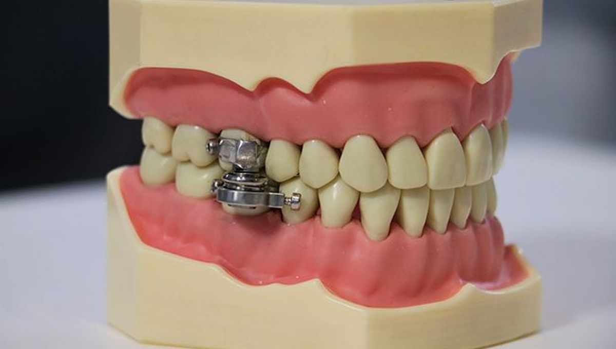 Scientists Develop Weight Loss Device That Locks Jaws Shut And People Are Not Happy