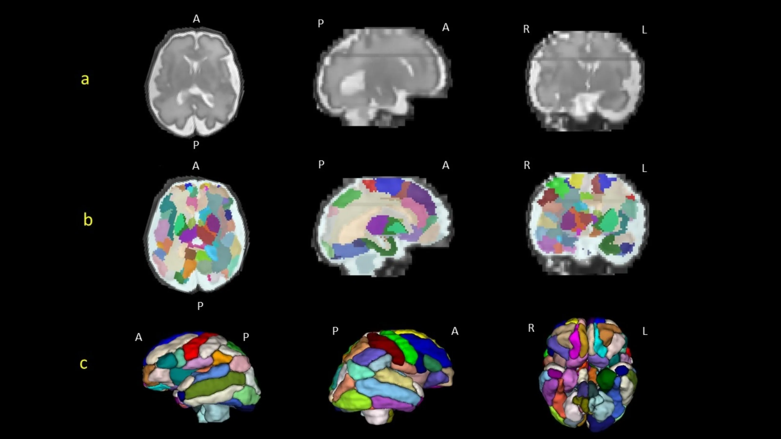 Brain Differences Linked To Autism Could Be Spotted Three Months