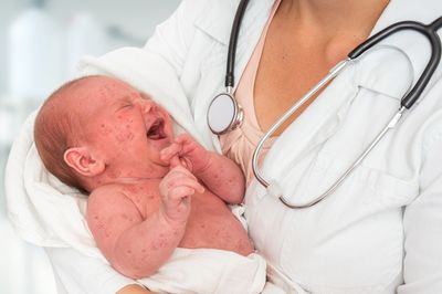 Newborn baby with measles