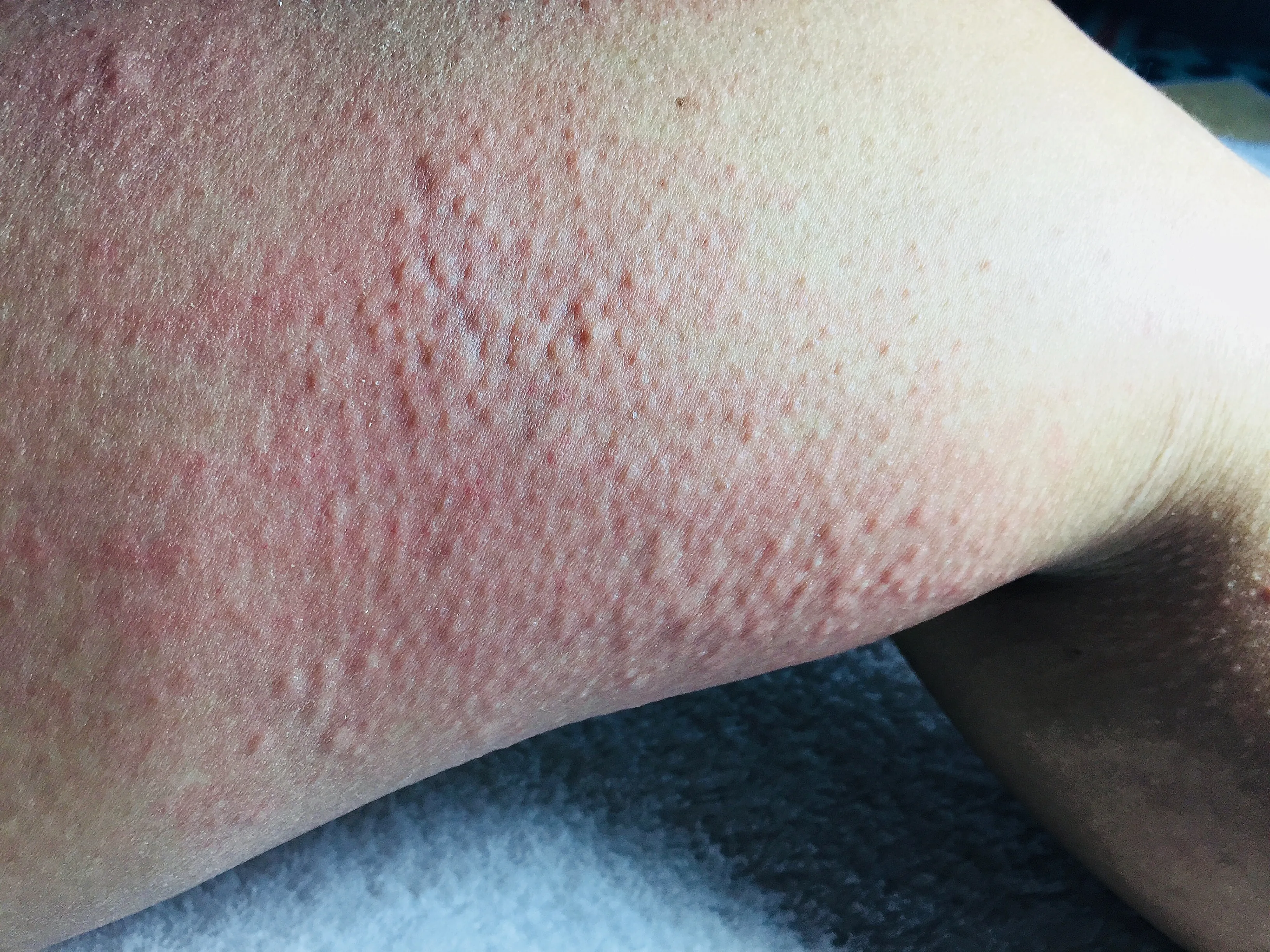 Cold Urticaria On Face Cold Urticaria On Face