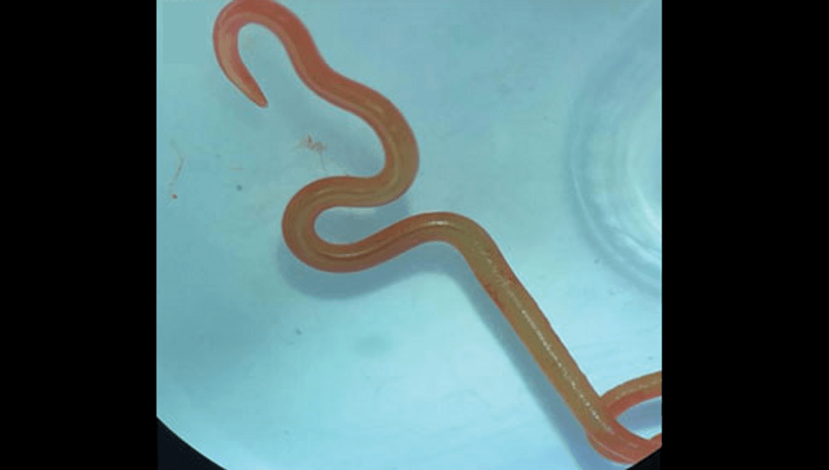 8 Centimeter Parasitic Worm Pulled Alive From Woman S Brain In World 8 Centimeter Parasitic Worm Pulled Alive From Woman S Brain In World