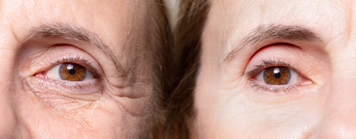 One Twin Had Regular Botox‚ The Other Didn’t. This Is What Happened.