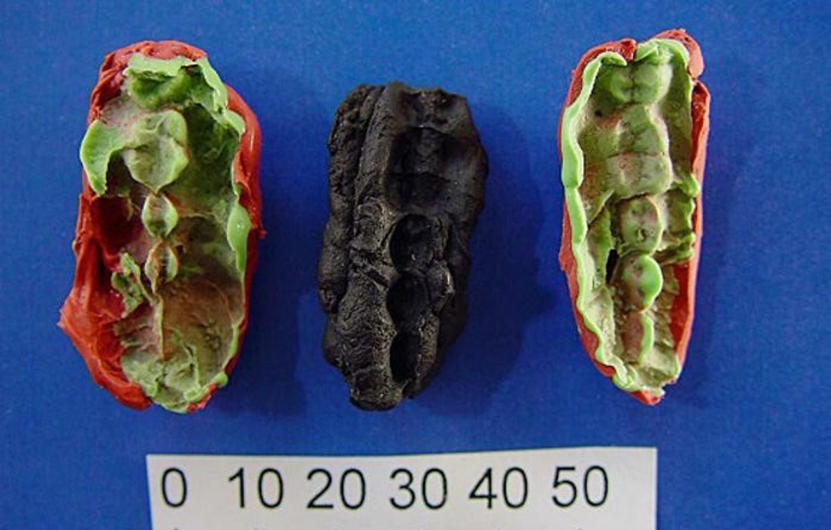 10‚000-Year-Old Chewing Gum Reveals Stone Age Diet And Poor Oral Health
