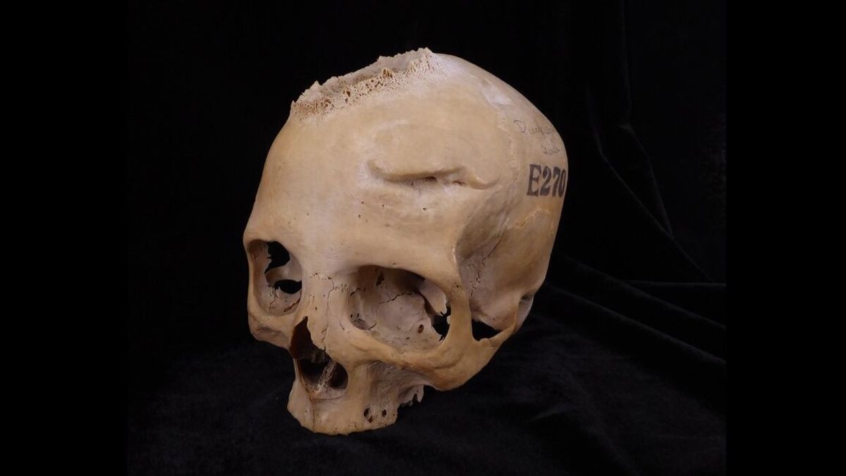 4,000-Year-Old Skulls Reveal Ancient Egyptian Cancer Treatment