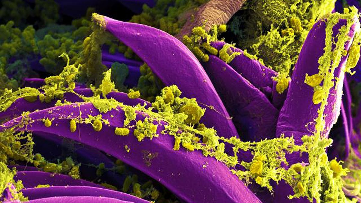 Human Plague Case In Colorado Confirmed By Officials