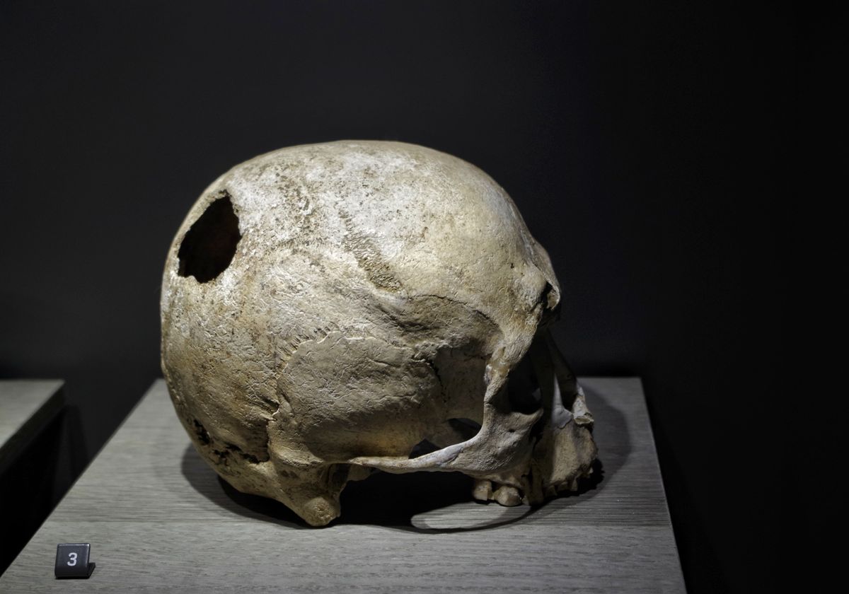 Neolithic Europeans Walked Around With 5.5-Centimeter Holes In Their Skulls