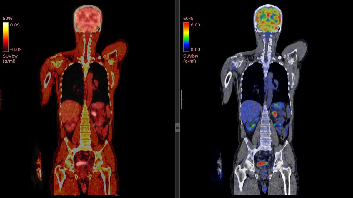 Signs Of COVID Virus In The Body Years After Original Infection