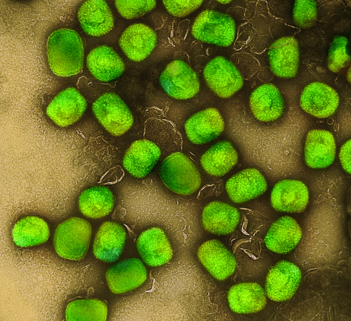 Mpox Detected In Sweden, The First European Case In The Latest Outbreak