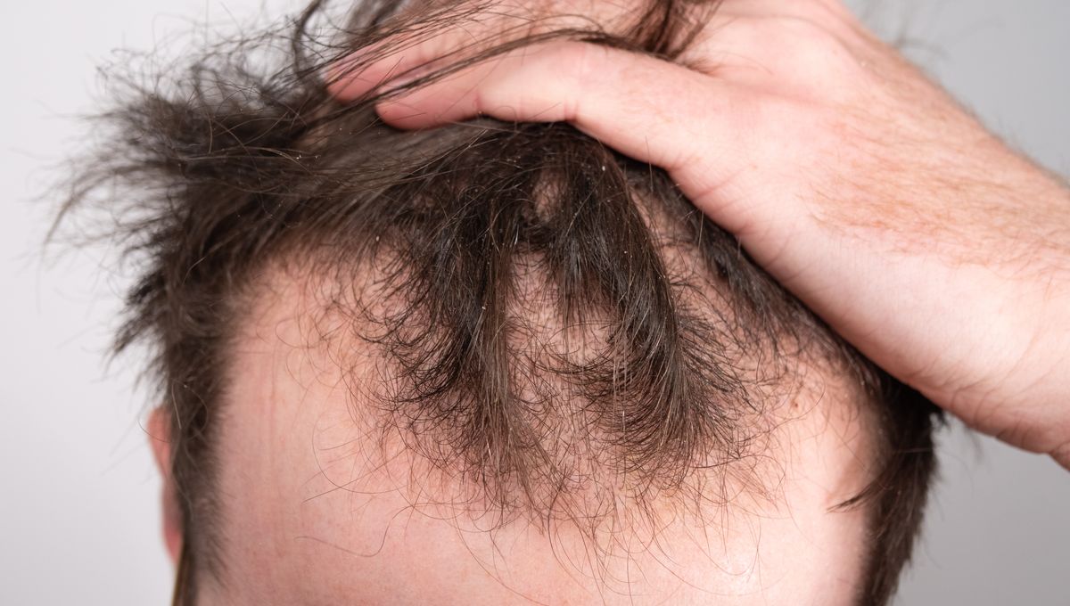 Scientists Discover Potential Cure For Male Pattern Baldness – And It’s Been Inside Us All Along | IFLScience