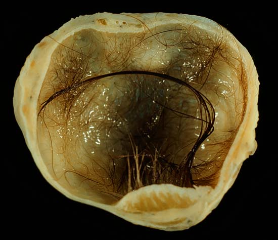 A mature cystic teratoma with hair inside
