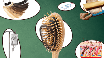 collage of images to do with hair loss, each on a white oval and all arrange on a dark green background, including an IV drip, hair extensions, hairbrush full of hair, molecular structure of dihydrotestosterone, someone straightening blonde hair, and a cross section of human skin
