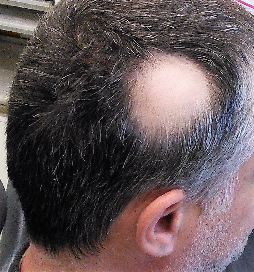 close up of man's head with a patch of hair loss near the right ear