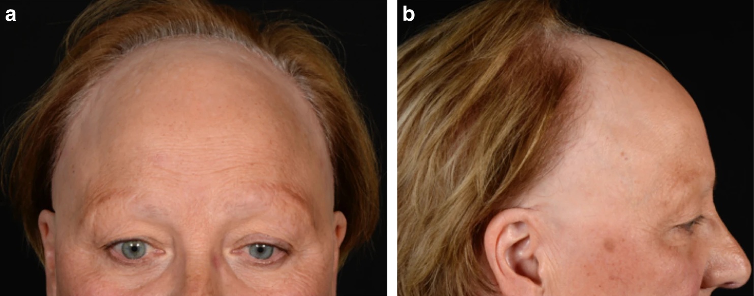 close up of woman's face showing only the eyes upwards; the hairline has receded substantially due to frontal fibrosing alopecia