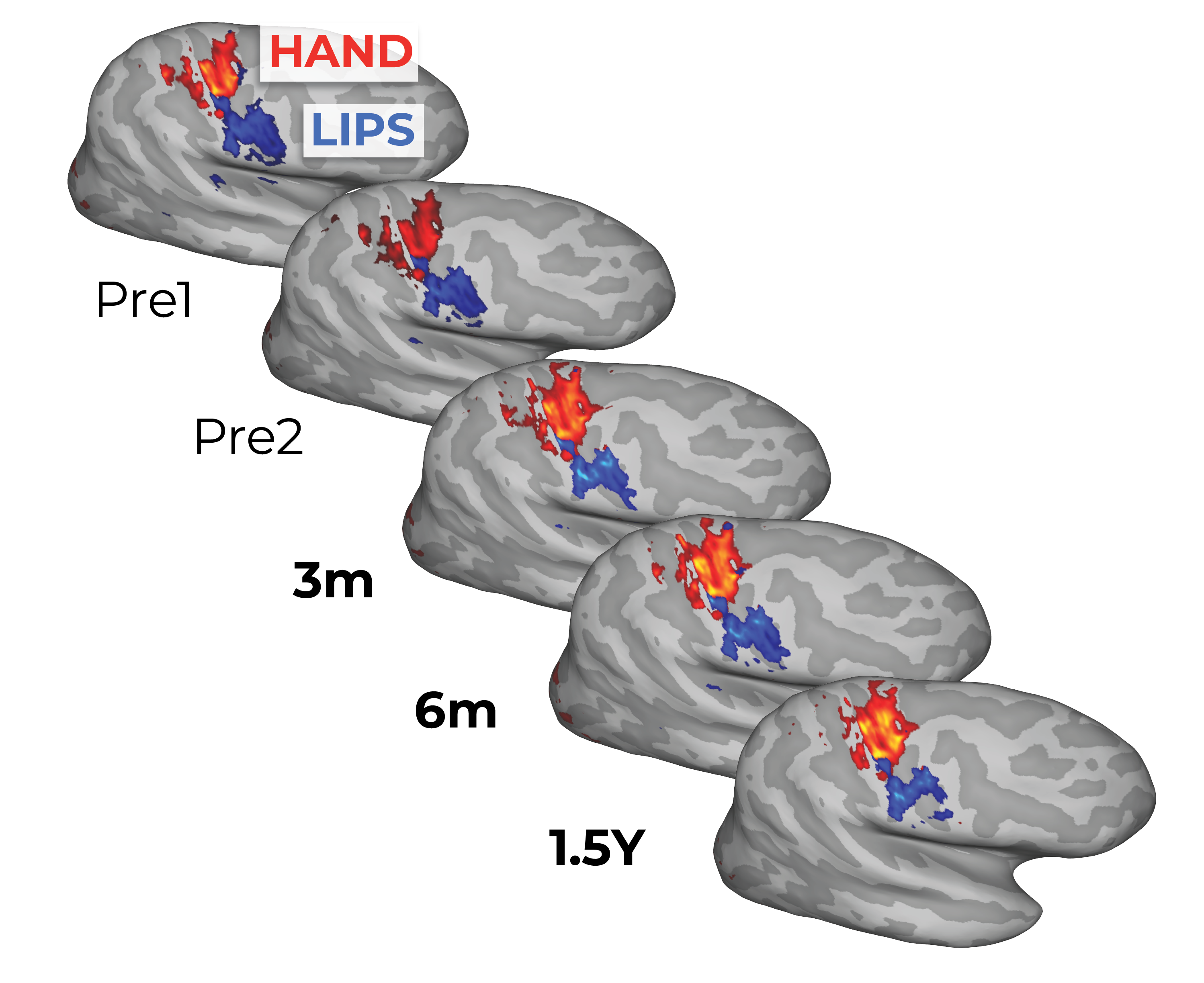 diagrams of the brain in gray with red and blue sections labelled as hand and lips respectively; they're arranged downwards from left to right in a diagonal line and labelled Pre1, Pre2, 3m, 6m, and 1.5Y. There is very little change in the images over time.