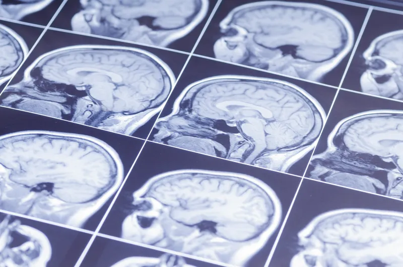 MRI scan pictures of the human brain