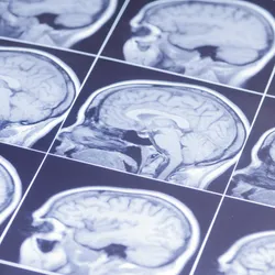MRI scan pictures of the human brain