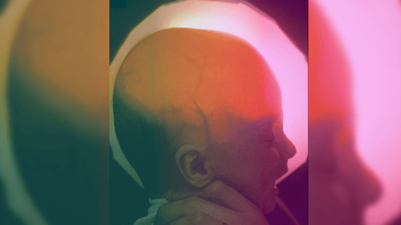 photo of baby with hydranencephaly; a light behind the infant's head reveals the lack of a cerebrum