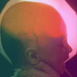 photo of baby with hydranencephaly; a light behind the infant's head reveals the lack of a cerebrum