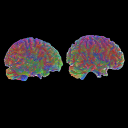 MRI tractography images of the five stages of brain age: childhood, adolescence, adulthood, early aging, and late aging.