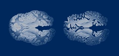 illustration of axial view of human brain with a healthy brain on the left and one damaged by dementia on the right