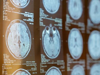 A photo showing multiple MRI scans of someone's brain arranged as a grid. 