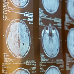 A photo showing multiple MRI scans of someone's brain arranged as a grid.