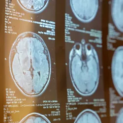 iflscience.com - Dr. Russell Moul - Groundbreaking Discovery Of Two MS Subtypes Could Lead To New Targeted Treatments