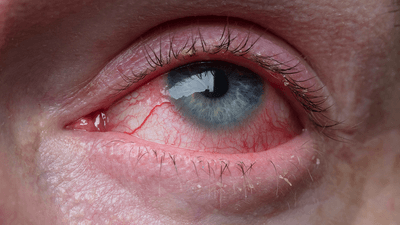 A bloodshot eye, looking up.