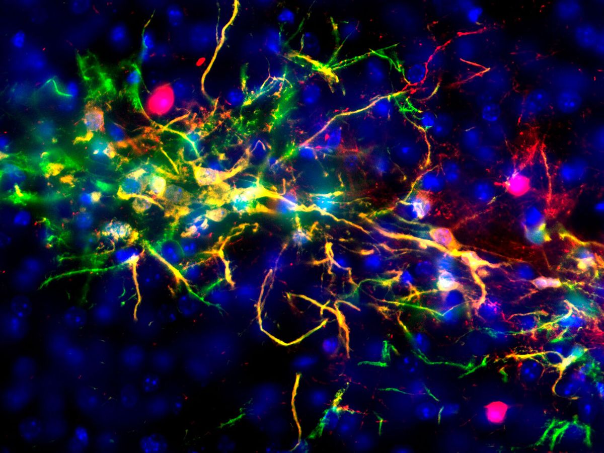 Why Do More Women Than Men Get Alzheimer’s? Scientists Think They’ve Begun To Figure It Out