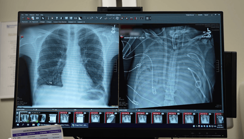 A comparison of the patient's healthy new lungs (left) and diseased old ones, but it's what was done in between that really mattered. 