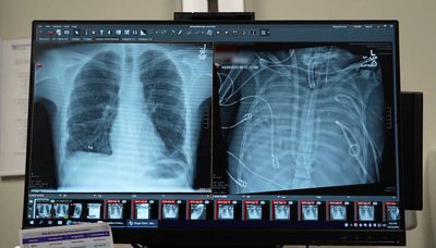 A comparison of the patient's healthy new lungs (left) and diseased old ones, but it's what was done in between that really mattered. 