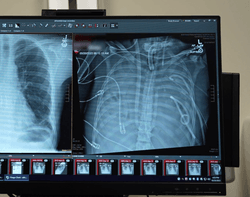 A comparison of the patient's healthy new lungs (left) and diseased old ones, but it's what was done in between that really mattered. 