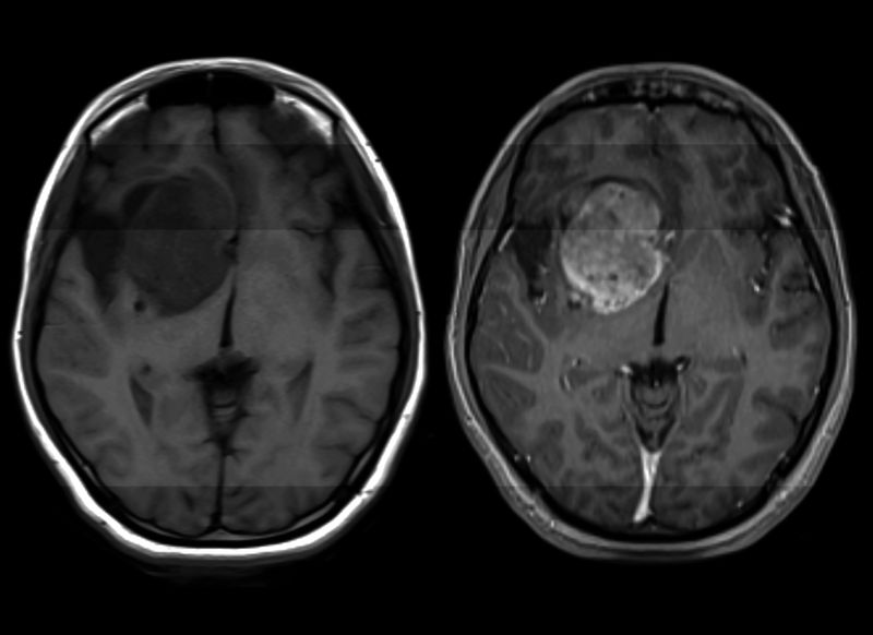 MRI scan showing high-grade glioma