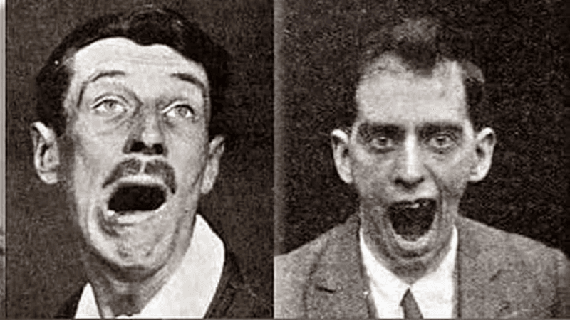 Patients with Encephalitis lethargica.