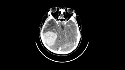 a meningioma on a CT scan