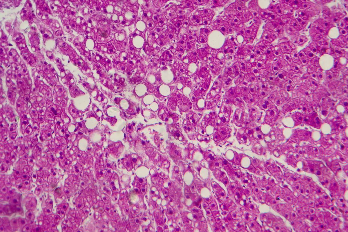 Cannabis Compounds Could Help Treat A Common Liver Condition That Affects Nearly A Quarter Of US Adults