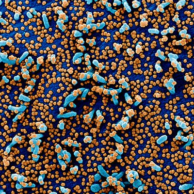 Colorized scanning electron micrograph of a VERO E6 cell (blue) heavily infected with SARS-COV-2 virus particles (orange), isolated from a patient sample.