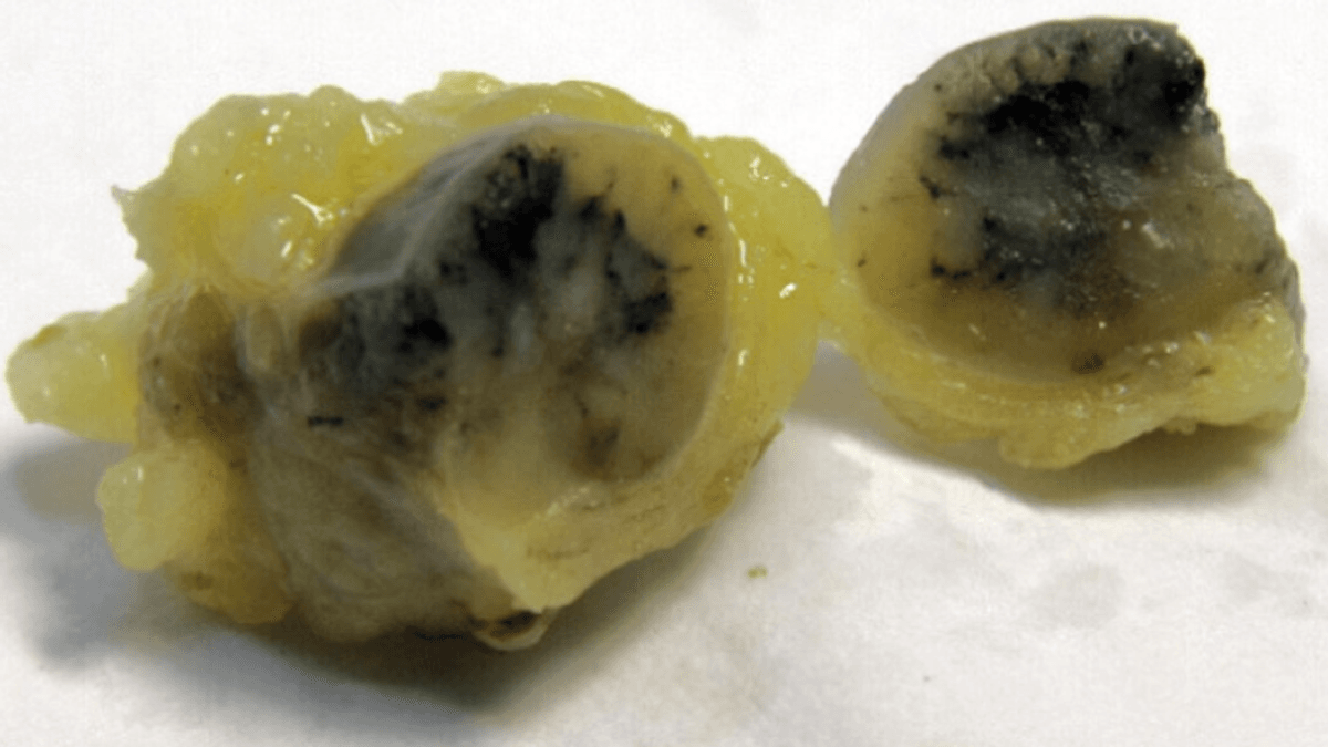 The Curious Reason Some Corpses Have Technicolor Lymph Nodes