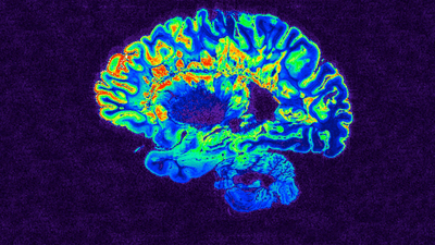 This is a pseudo-colored image of high-resolution gradient-echo MRI scan of a fixed cerebral hemisphere from a person with multiple sclerosis.